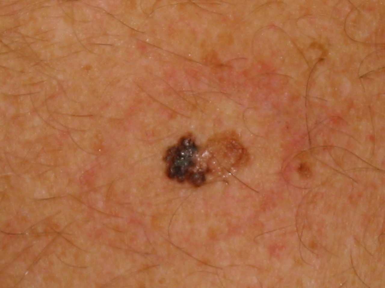 Bildquelle: uv-check.de; am 26.6.12 abgerufen MalignesMelanomRueckenSchwarzerHautkrebs